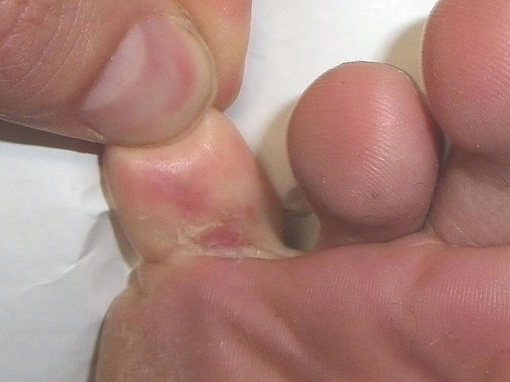 Foot Fungal Infection Between Toes