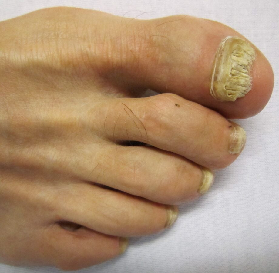 Fungal nail inection - close up of forefoot