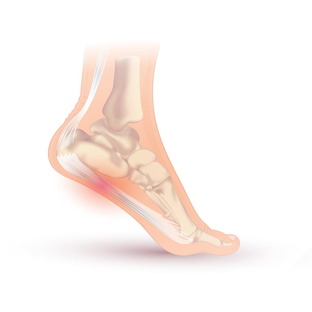 Plantar fasciitis diagram