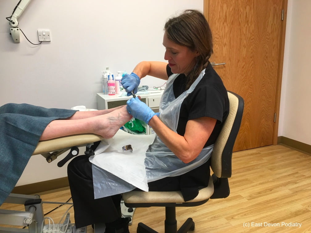 Sidmouth Podiatrist Sue Pyle cutting toenails